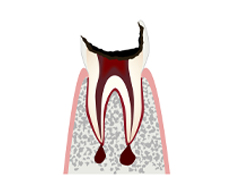 C4　末期の虫歯